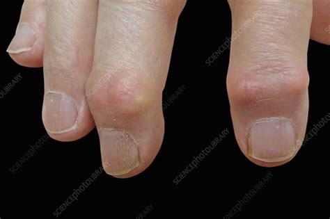 Gout affecting the hand - Stock Image - C045/9579 - Science Photo Library