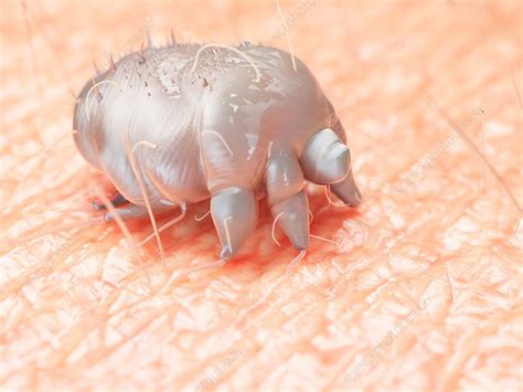 Illustration of a scabies mite on human skin - Stock Image - F023/7765 - Science Photo Library