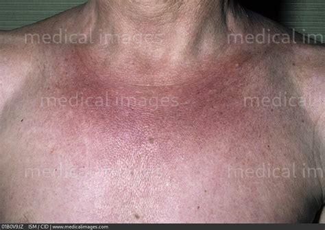 STOCK IMAGE, plaque scleroderma morphea also known as localized scleroderma on the chest c cid ...