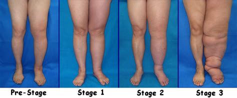 Lymphedema- Causes, Stages, Lymphatic System and Treatment