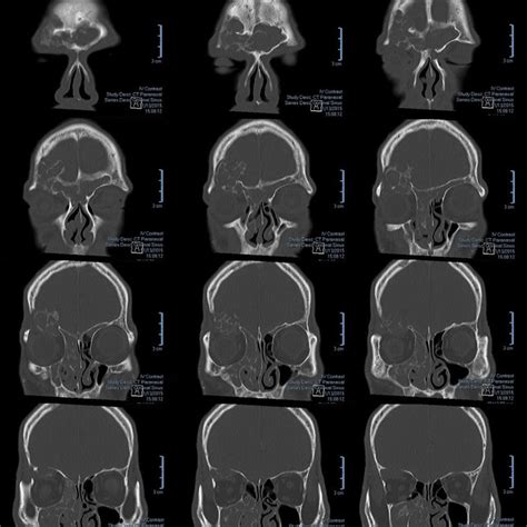 Nasoendoscopy showing right anterior nasal space entirely obscured by... | Download Scientific ...