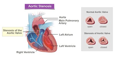 Aortic Valve Stenosis | Boston Children's Hospital