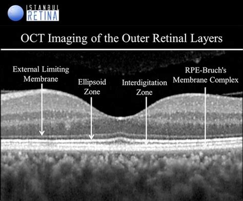 Normal OCT Anatomy | OCT Club