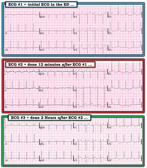 Dr. Smith's ECG Blog: What does this ECG with significant ST Elevation ...