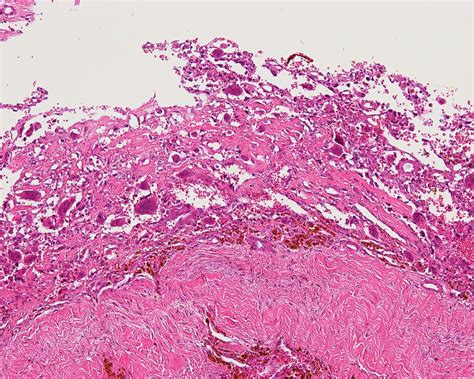 Telangiectatic Osteosarcoma