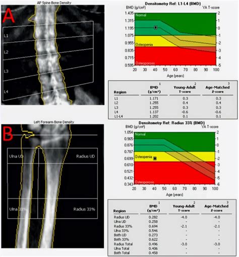 Osteoporosis Osteopenia