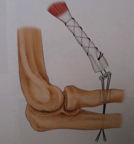 Distal Biceps Rupture | Distal Biceps Repair | Dr. Christopher S Ahmad