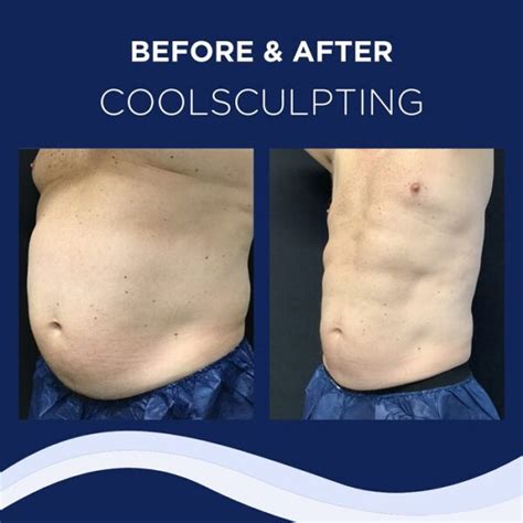 Coolsculpting Before and After: Results, Side Effects, and What to Expect - Must Read This ...