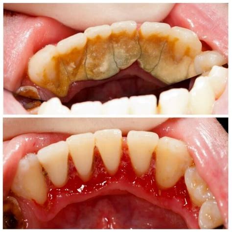 Teeth Cleaning Before and After - Teeth FAQ Blog | Làm răng, Nha khoa, Thực phẩm