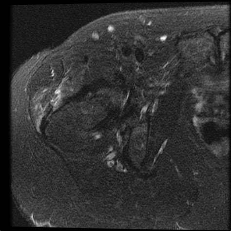 Synovial herniation pit - growing | Image | Radiopaedia.org