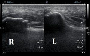 Ultrasound Images of Plantar Fasciitis - Ankle, Foot and Orthotic Centre