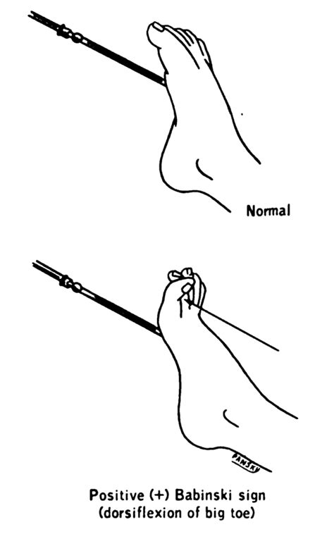 6.9 Assessing Reflexes – Nursing Skills – 2e