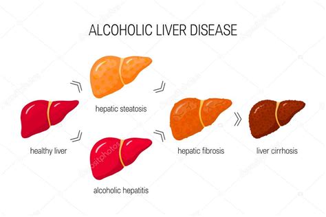 Stages Alcoholic Liver Disease Vector Illustration Healthy Liver | My ...