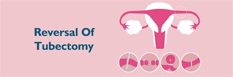 Reversal of Tubectomy: Why to Consider & Success Rate