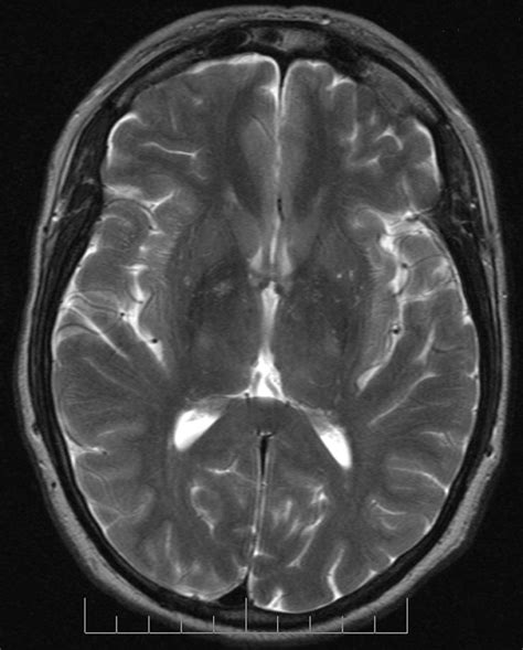 MRI_T2_Brain_axial_image | Medical Science Navigator