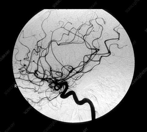 Internal Carotid Cerebral Angiogram - Stock Image - M136/0319 - Science ...