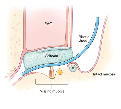 Staging Ossiculoplasty – Oto Surgery Atlas