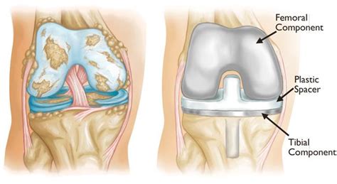 Total Knee Replacement - OrthoInfo - AAOS