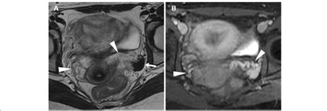 MRI of pelvic congestion syndrome in a 26-year-old woman with chronic ...