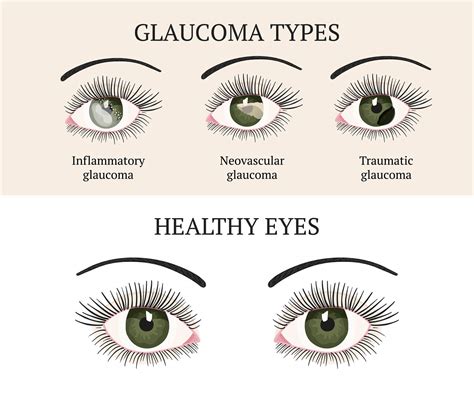 Natural Ways to Lower Eye Pressure