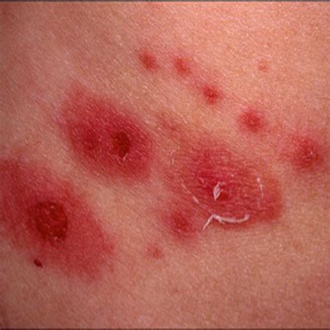 Shingles Symptoms Causes, Rash Treatment in Australia Sydney