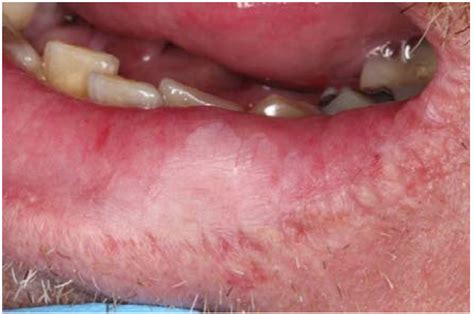 Cpt Code For Biopsy Of Lip Lesion | Sitelip.org