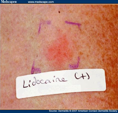 Contact Allergy to Lidocaine: A Report of Sixteen Cases