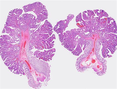 Villous Adenoma Histology