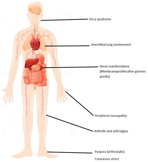 JCM | Free Full-Text | Persistence of Cryoglobulinemic Vasculitis after DAA Induced HCV Cure