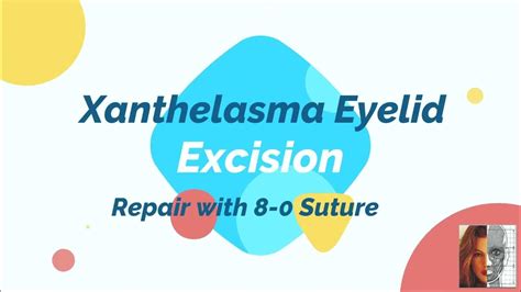 Xanthelasma Eyelid: Excision - YouTube