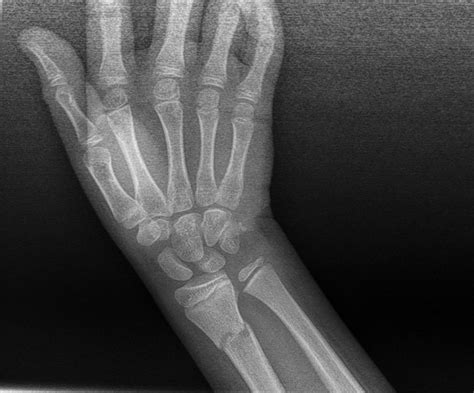 Greenstick Fracture X Ray