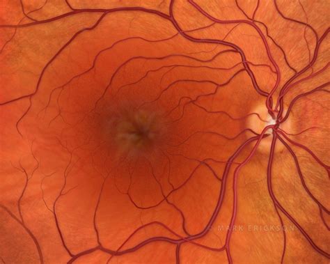 Cystoid macular edema (CME) illustrated patient education image