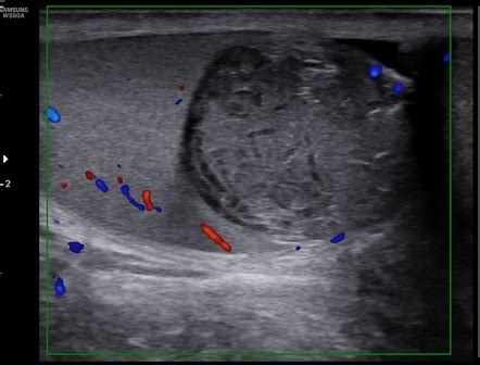 Testicular Epidermoid Cyst