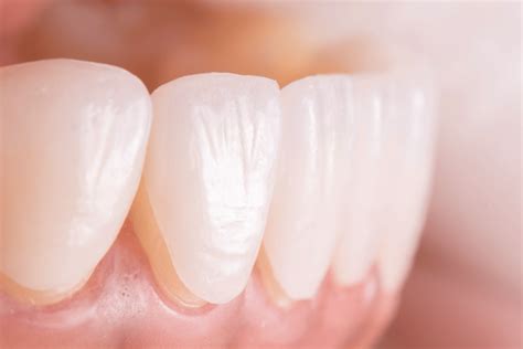 Dental Veneers - Fix Chipped, Gapped, or Misshapen Teeth