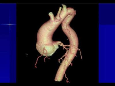 What is Thoracic Aortic Disease?