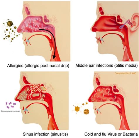 Postnasal Drip in Children - Pediatric Pulmonologists