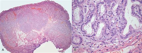 Photomicrography of the Brunner's gland hamartoma: A-central nodular ...