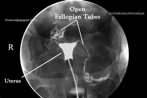 Hysterosalpingogram procedure, uses & hysterosalpingogram side effects