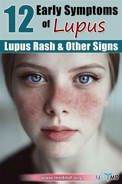 Lupus Symptoms Face Rash Remedies, Subacute Cutaneous Lupus, Systemic Autoimmune Disease ...