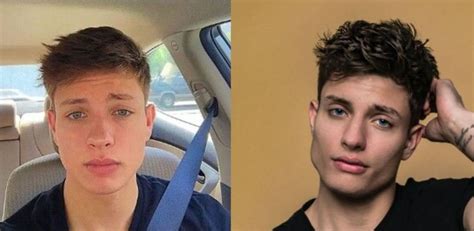 Matt Rife Pre Plastic Surgery: Before And After Photo