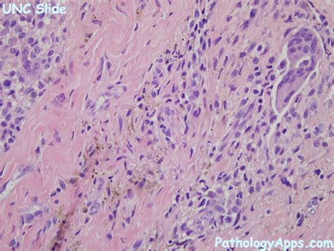 Giant Cell Tumor Histology