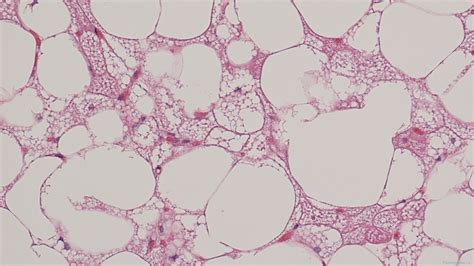 Hibernoma | Atlas of Pathology