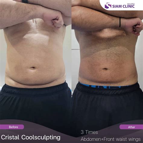 Cristal Cryolipolysis result - Siam Clinic - Aesthetic & Wellness Clinic in Phuket