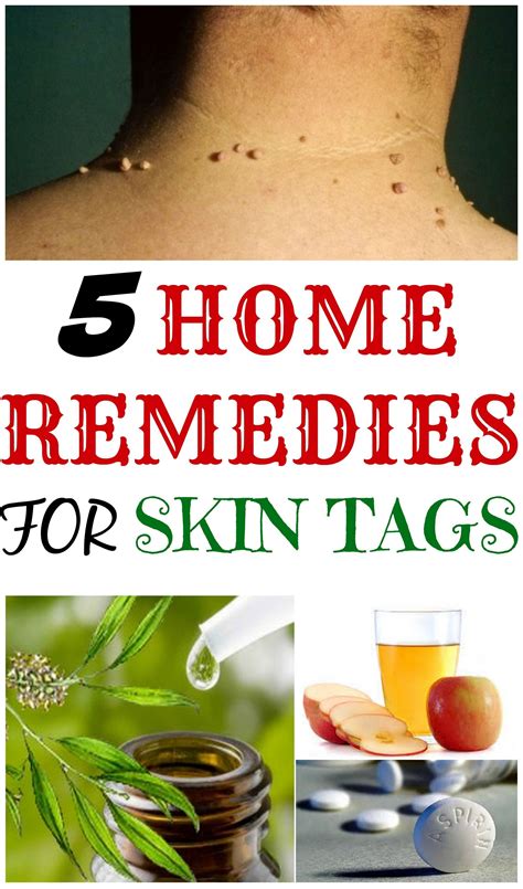 List of 8 home remedies to remove skin tags Trend in 2022 | Best Home ...