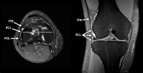 Fibular Collateral Ligament Mri