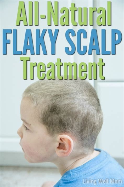 All-Natural Flaky Scalp Treatment {For Kids & Adults} - Living Well Mom