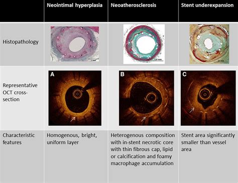 Restenosis of Drug-Eluting Stents | Circulation: Cardiovascular Interventions