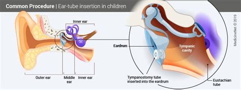 Ear Tubes Surgery: Placement Procedure in Toddlers & Adults - Okkii.com