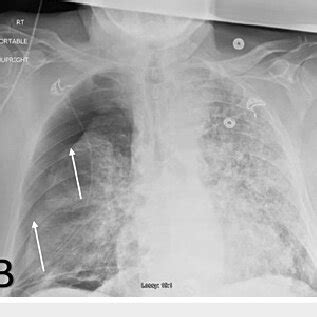 Anterior-Posterior chest x-ray on admission A). Anterior-Posterior ...