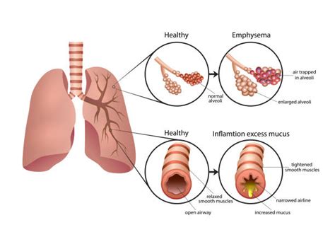 Endothelial cell treatment reverses lung damage in mice with emphysema | The Stem Cellar